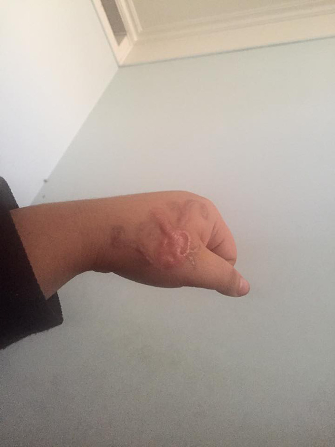 dan mang chia se chuyen di xoa xam dau mot lan roi thoi nhung de lai vet seo xau xi ca doi