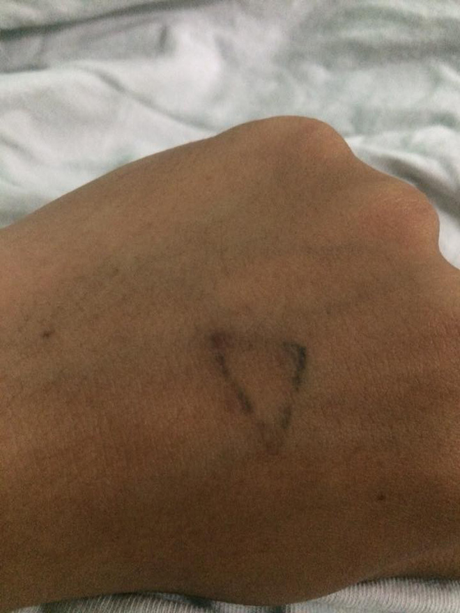 dan mang chia se chuyen di xoa xam dau mot lan roi thoi nhung de lai vet seo xau xi ca doi