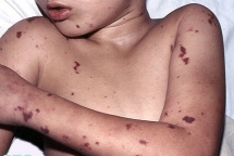 bo y te yeu cau cac tinh giam sat phat hien som benh viem nao mo cau