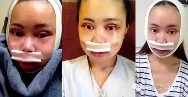 nhung co gai tre bat chap ca mang song de phau thuat tham my thanh ban sao cua than tuong