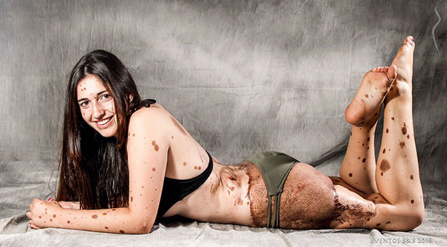 co gai nay tung bi treu choc tan nhan vi co 500 vet bot vay nhung hay nhin co ay o hien tai