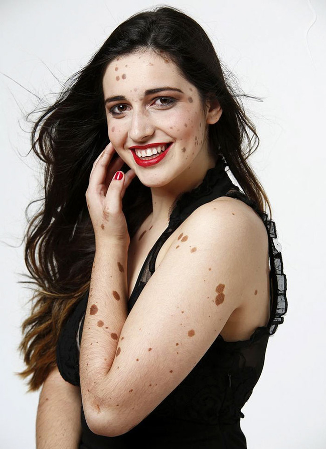 co gai nay tung bi treu choc tan nhan vi co 500 vet bot vay nhung hay nhin co ay o hien tai