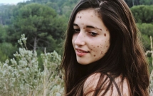 co gai nay tung bi treu choc tan nhan vi co 500 vet bot vay nhung hay nhin co ay o hien tai