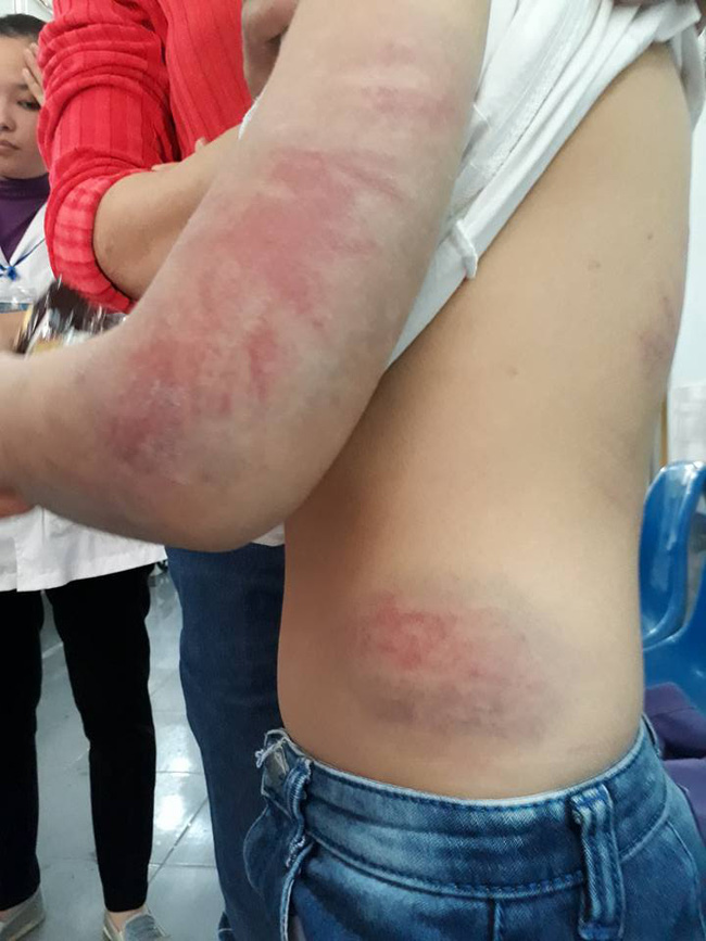 vinh phuc bo say ruou danh con gai 6 tuoi bam dap khap co the phai di benh vien