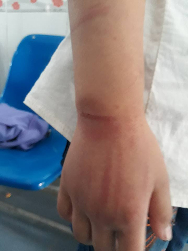 vinh phuc bo say ruou danh con gai 6 tuoi bam dap khap co the phai di benh vien