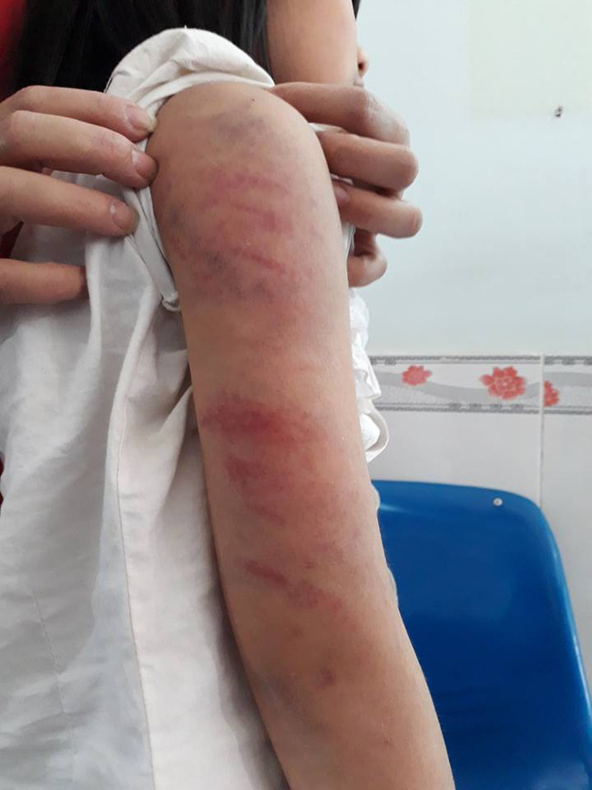 vinh phuc bo say ruou danh con gai 6 tuoi bam dap khap co the phai di benh vien