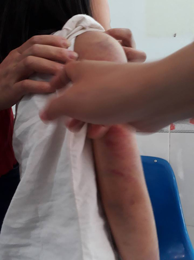 vinh phuc bo say ruou danh con gai 6 tuoi bam dap khap co the phai di benh vien