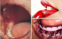 giam doc bv da lieu tw me bau dung son moi nhiem doc chi con de mac bien chung tam than di dang