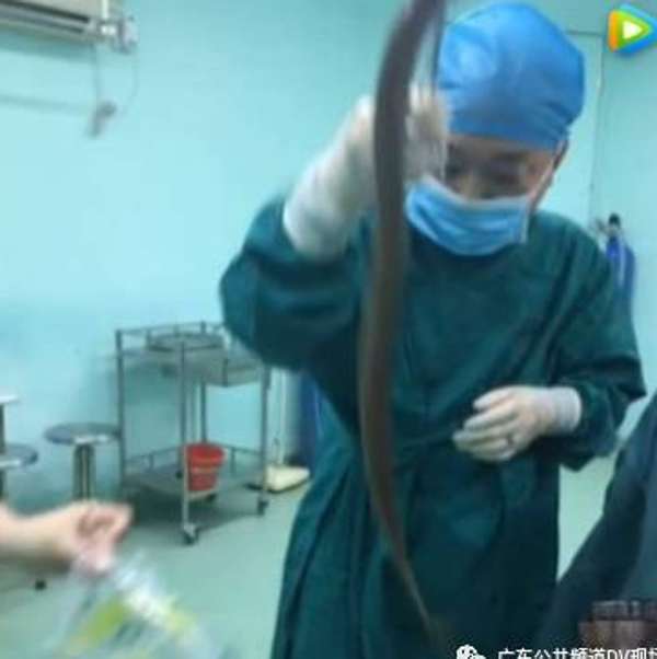 nguoi dan ong nhet luon dai nua met vao hau mon de chua tao bon may duoc bac si phau thuat kip thoi