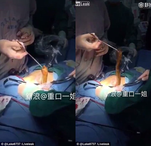 rung minh khoanh khac bac si phau thuat gap luon ra khoi bung benh nhan gap nan vi tu suong