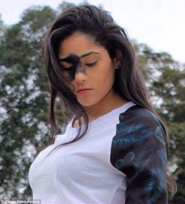 sinh ra da co vet bot sam mau tren mat 24 nam sau co gai thuc su toa sang voi ve dep la cua minh