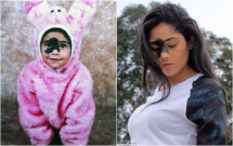 sinh ra da co vet bot sam mau tren mat 24 nam sau co gai thuc su toa sang voi ve dep la cua minh