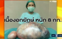 tuong beo phi benh nhan di kham va phat hien ra khoi u khong lo trong buong trung nang 8kg