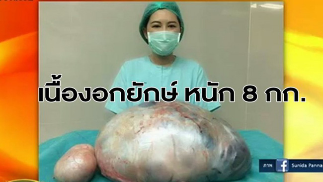 tuong beo phi benh nhan di kham va phat hien ra khoi u khong lo trong buong trung nang 8kg