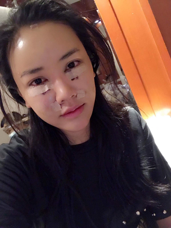 sao viet dang co xu huong cong khai qua trinh phau thuat tham my tren mang xa hoi