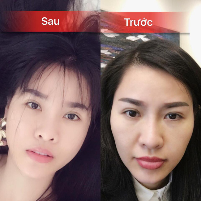 sao viet dang co xu huong cong khai qua trinh phau thuat tham my tren mang xa hoi