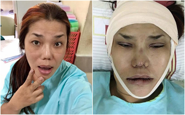 sao viet dang co xu huong cong khai qua trinh phau thuat tham my tren mang xa hoi