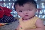 thuong tam be 1 tuoi co the bi mu vi bo me khong co tien phau thuat