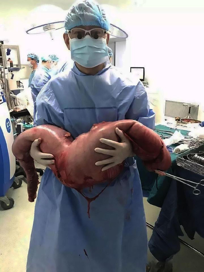 mo bung benh nhan bac si ta hoa khi phat hien khoi dai trang dai 76cm do bi tao bon nhieu nam