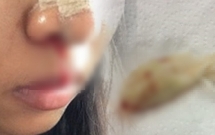 co gai suyt tac tho vi bac si tham my quen lay bang gac trong mui benh nhan