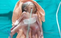 cuoc song ngan ngui cua be gai chi co mot dau nhung dinh lien voi hai than tach biet