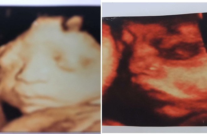 me cua nguoi vo di sinh nhung khong mang con ve khien chong quan tri tu tu o bac giang bac si noi con toi bi tram cam nang