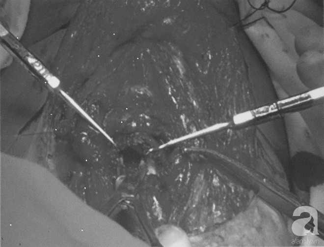 bac si viet cuu chang trai campuchia 2 nam troi khong noi khong tho duoc bang mui