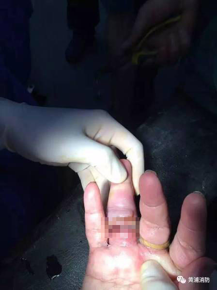 chi vi muon khoe khoang nguoi phu nu deo 10 chiec nhan da phai cap cuu vi go mai khong ra