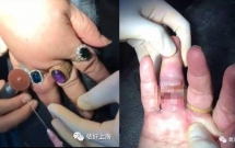 chi vi muon khoe khoang nguoi phu nu deo 10 chiec nhan da phai cap cuu vi go mai khong ra