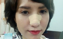 hong xuan len tieng ve vu chan thuong mui sau au da tai vietnams next top model