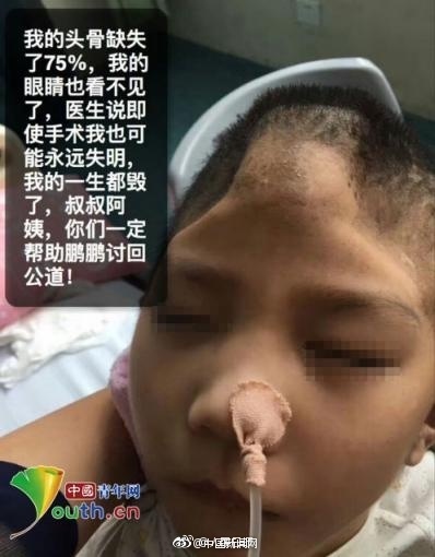 bi me ke nguoc dai da man cau be 6 tuoi chan thuong so nao nghiem trong