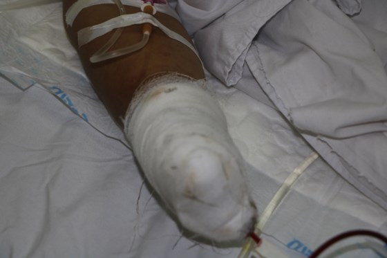 cap cuu benh nhan bi soc da chan thuong nang do no min danh ca