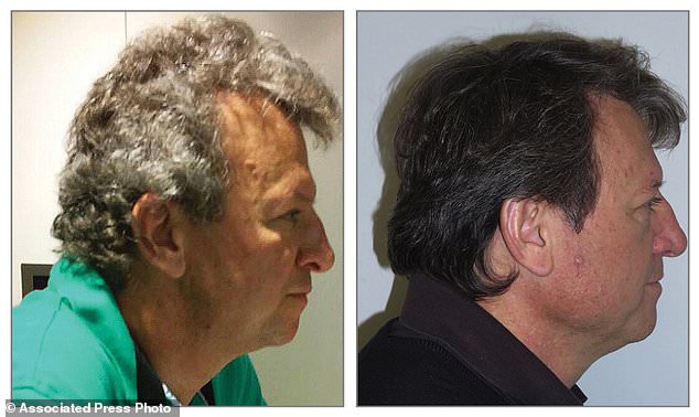 bat ngo benh nhan hoa tri ung thu khong bi rung toc va chuyen sang mau den