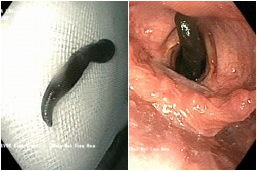 binh dinh con vat dai 10cm nam trong khi quan benh nhan