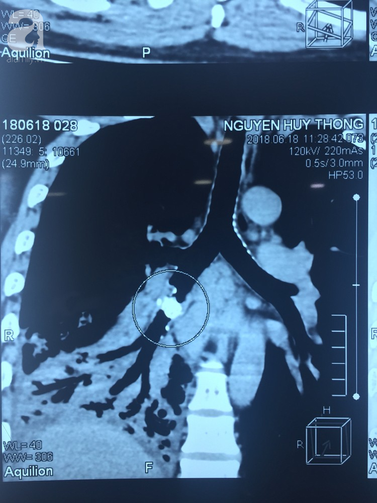 hoc xuong ca nhung khong dieu tri dut diem 5 nam sau nguoi dan ong phai cat bo nua la phoi