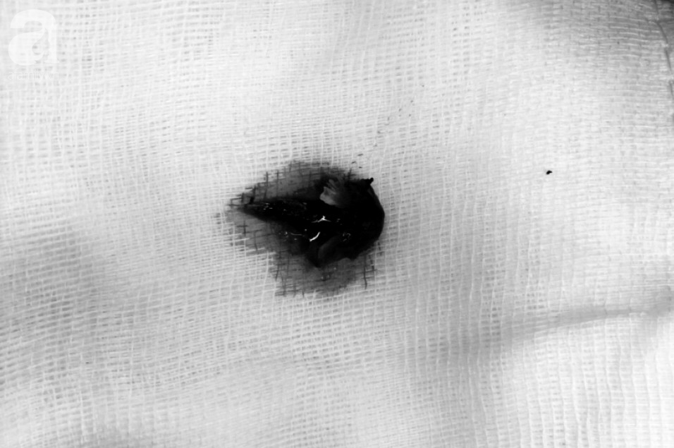 hoc xuong ca nhung khong dieu tri dut diem 5 nam sau nguoi dan ong phai cat bo nua la phoi