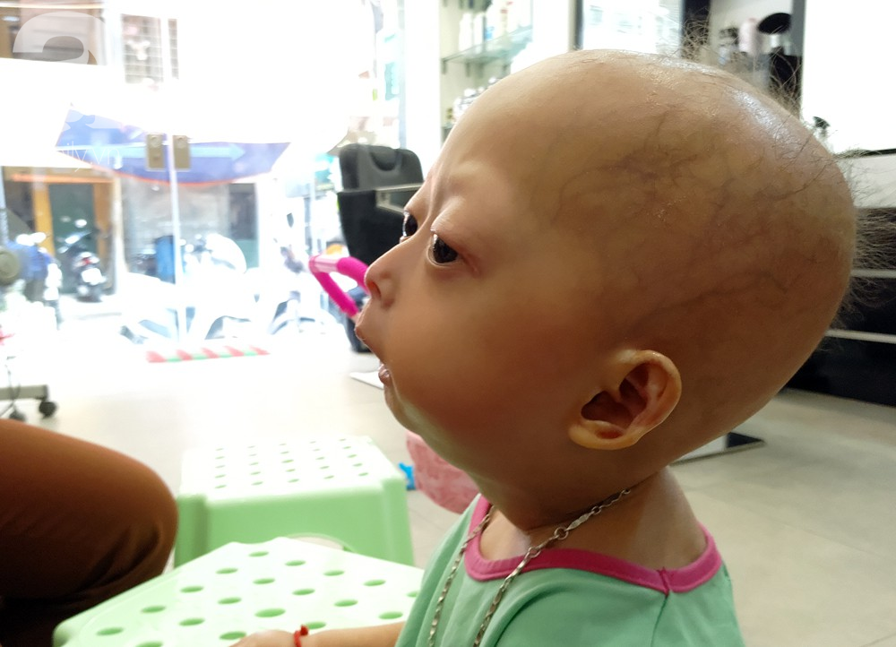 me cua 2 be gai bi dau co veo lech o tuyen quang gia nhu con khoi benh du danh doi gi toi cung cam long