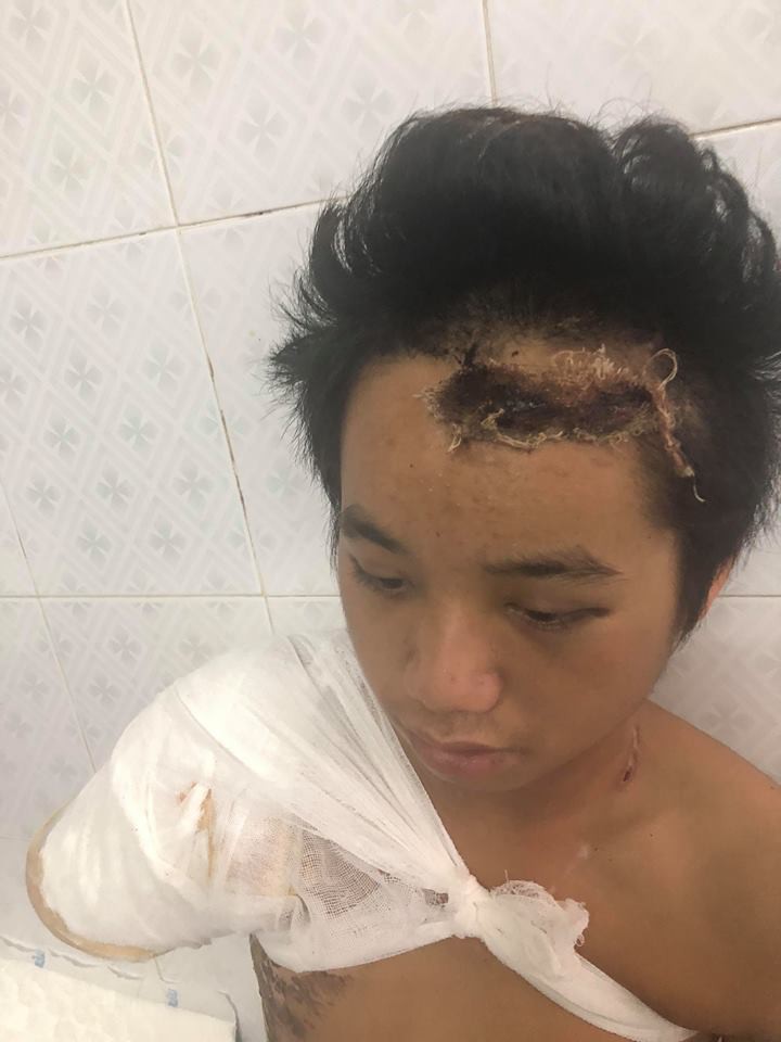 bo chet me bo di bien biet chang trai dang mot minh nuoi 5 em nho bong bi dien giat cut tay song lay lat