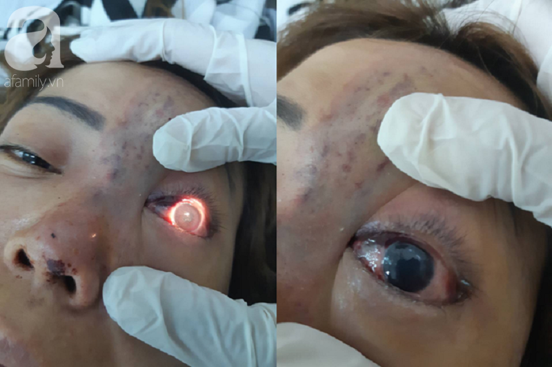 tphcm nguoi phu nu 30 tuoi bi mu hoan toan mat trai vi tiem filler nang mui