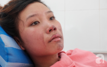 Lên Sài Gòn làm việc phụ mẹ nuôi em, thiếu nữ 18 tuổi bị bình gas mini làm bỏng nặng