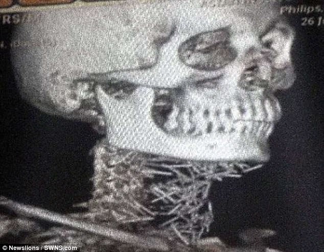 4 thang rong vai tu phuong khong ra benh bac si kinh ngac khi nhin phim x quang cua benh nhan