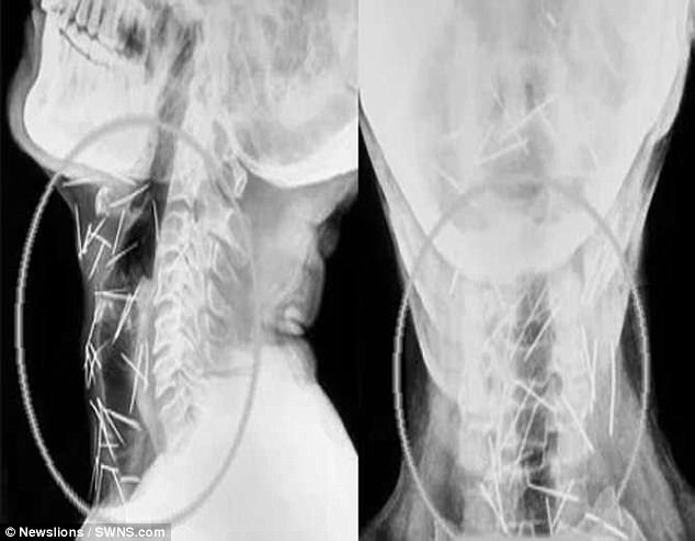 4 thang rong vai tu phuong khong ra benh bac si kinh ngac khi nhin phim x quang cua benh nhan