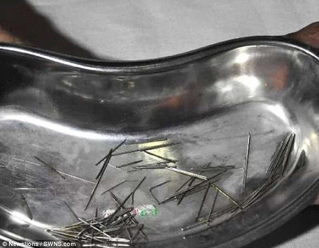 4 thang rong vai tu phuong khong ra benh bac si kinh ngac khi nhin phim x quang cua benh nhan