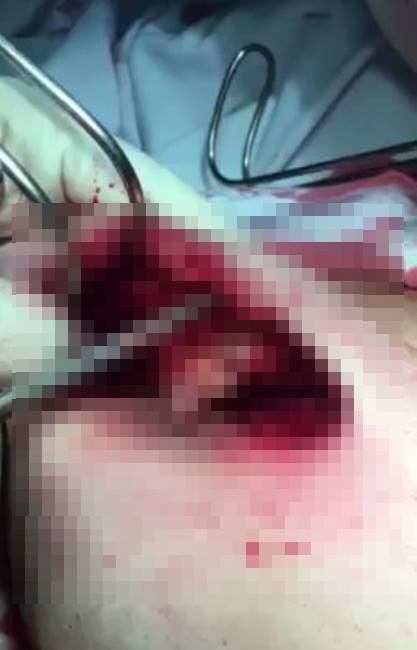 tphcm nang nguc khi dang mang thai co gai 22 tuoi tu vong vi bien chung