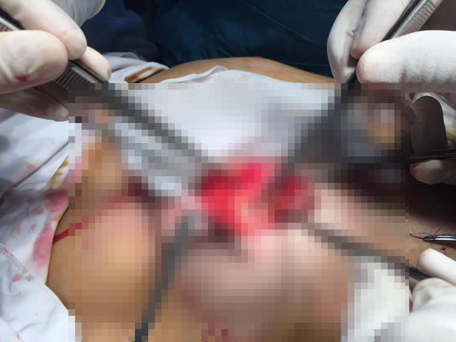 tphcm nang nguc khi dang mang thai co gai 22 tuoi tu vong vi bien chung