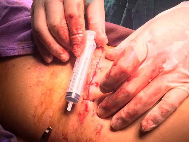 quang ninh cuu song thanh nien bi dam trong thuong thau thanh bung