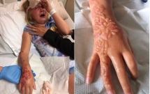 duoc bo thuong cho ve henna len tay be gai 7 tuoi da phai khoc dau don khi canh tay bong rop dang so