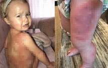 cuoc hanh trinh chong lai su ky thi cua mot be gai mac benh vay nen