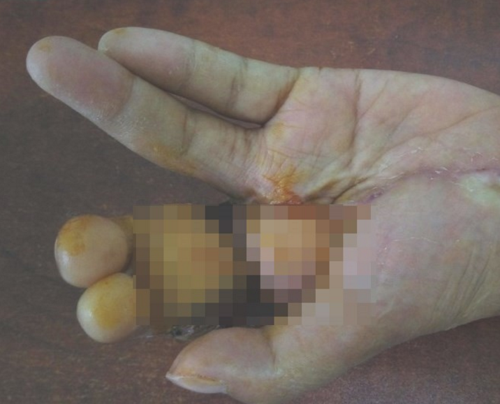 bien 2 ngon chan thanh 2 ngon tay cho benh nhan nu 26 tuoi