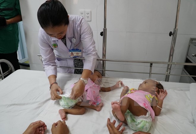 lan dau tien phau thuat thanh cong cap song sinh dinh nhau